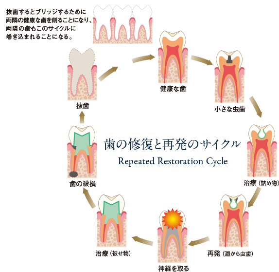 歯の修復と再発サイクル